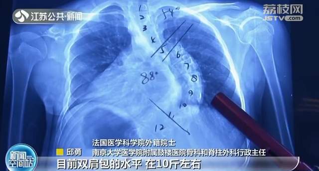 书包太重导致脊柱侧弯？专家：关系真的不大_腾讯新闻