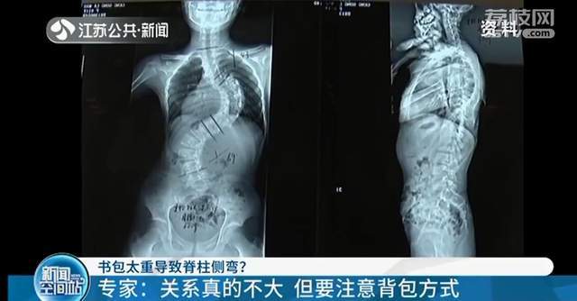 書包太重導致脊柱側彎?專家:關係真的不大_騰訊新聞