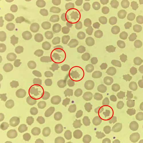 患者外周血涂片可见红细胞大小不一,棘形红细胞占17%(正常人棘红细胞