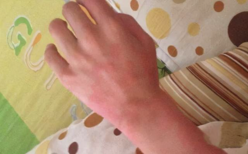 炎炎夏日来临,极容易忽视的4类皮炎,看过的人早预防_腾讯新闻