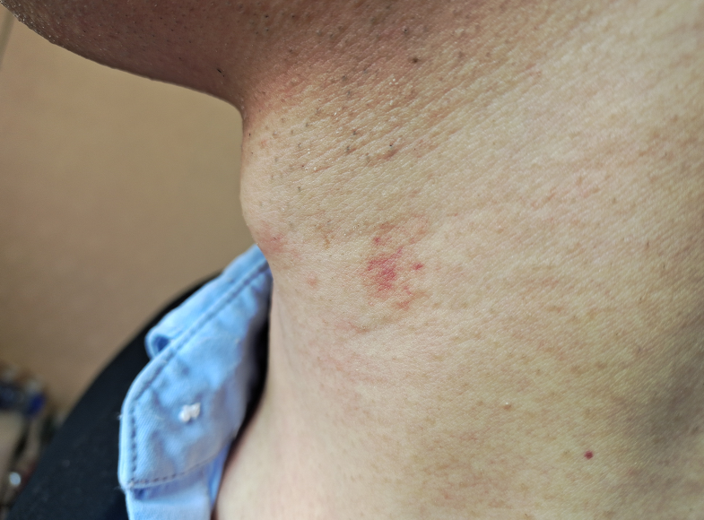 男子脖子上出现"吻痕"?女友一怒之下要分手!