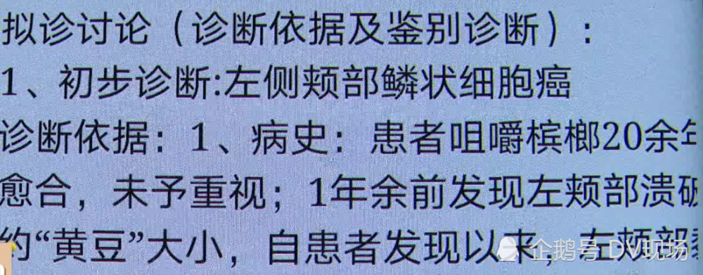 惠州男子一天嚼两包槟榔竟诱发恶性口腔癌