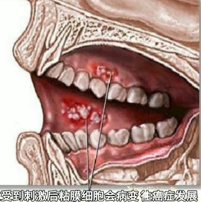 惠州:男子一天嚼两包槟榔,竟诱发恶性口腔癌_腾讯新闻