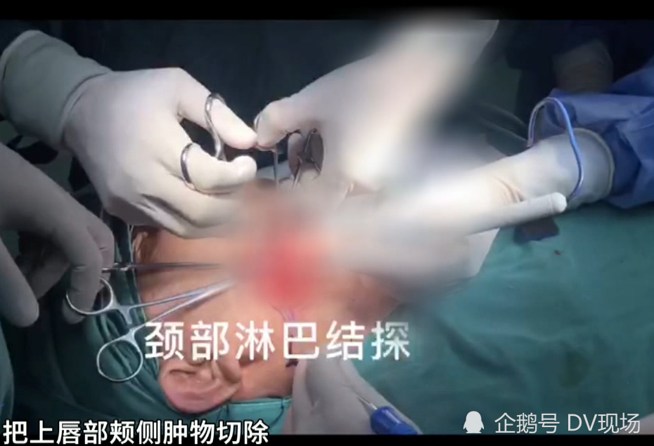 惠州男子一天嚼两包槟榔竟诱发恶性口腔癌