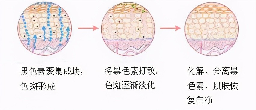 超皮秒就是通过直接粉碎黑色素的原理,毕竟黑色素也是造成人皮肤黑的