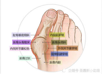 上海大脚骨整形哪里好 费用多少钱这家治外翻脚骨效果好 非常爱美