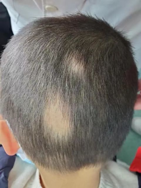 去除可能诱发斑秃的因素,一般可以在6~12个月内自然痊愈
