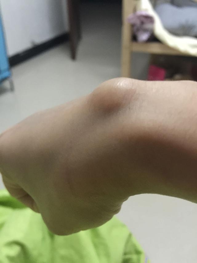 联想到身边几个有腱鞘囊肿的同事,我惊讶地发现,果然都是家里有小孩的