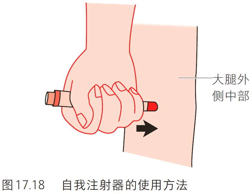 针尖对准大腿外侧中部肌肉最多处(有没有衣服皆可).