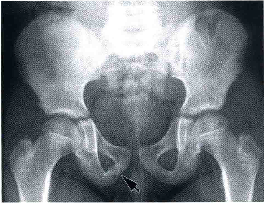 易误诊的骨盆假性骨折 正常骺线 腾讯新闻