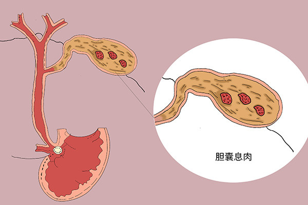 什麼情況下需要切除膽囊沒了膽囊的人生活中該如何保養