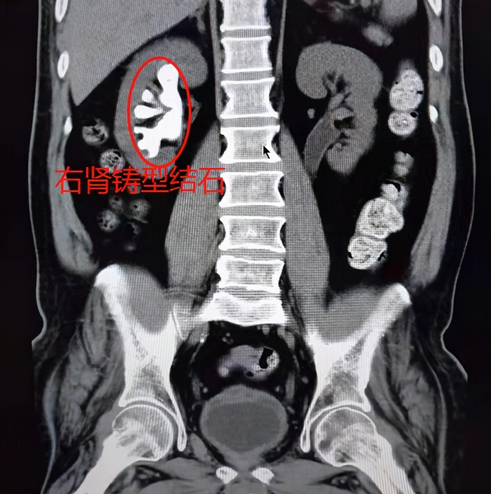 结石像水泥浇筑填充肾医生妙手打洞取石