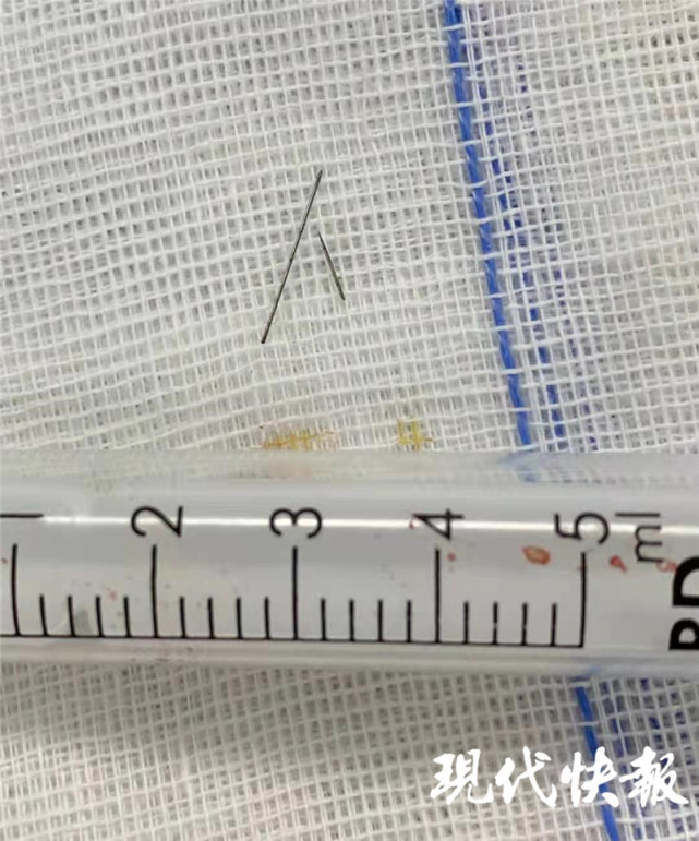 女子针灸时断针，1.5cm针头在体内自行游走……_腾讯新闻