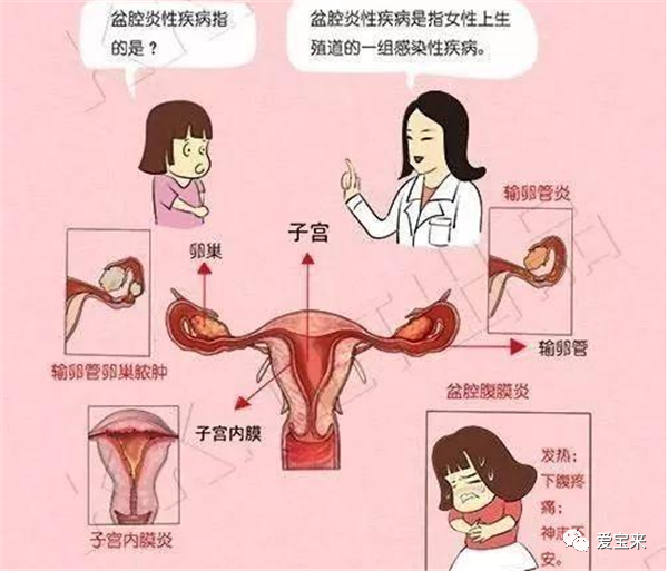 盆腔炎為什麼會導致不孕不育呢