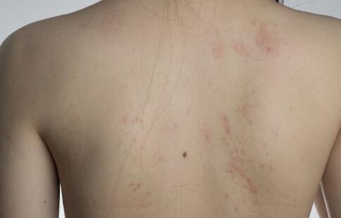 脂溢性皮炎反复总不好?怎么办?