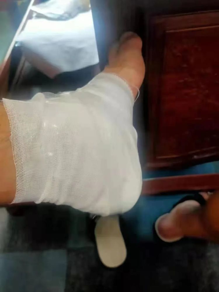 张伟余在撞门过程中,肩膀严重挫伤,脚被玻璃割伤事后,张伟余才发现