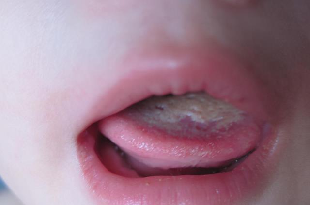 积食严重的孩子舌苔发白且厚重,还伴有口臭.