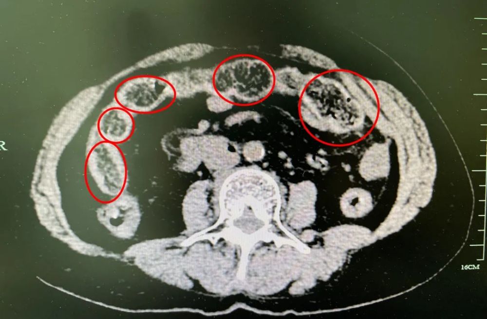 义乌一老人用尽全身力气排便结果
