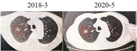 肺結節短期內快速增長一定是惡性腫瘤嗎?_騰訊新聞