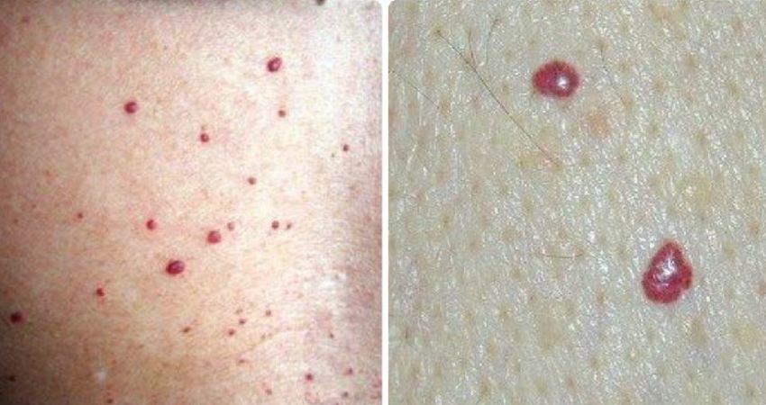 "我仔细看了之后,觉得就是一些普通的红痣,并不像与肝病有关的蜘蛛痣.