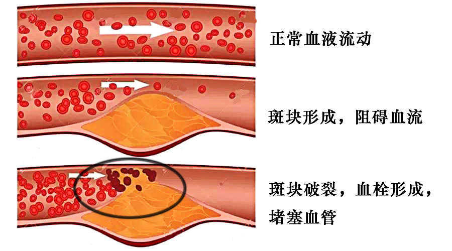 如何預防斑塊脫落?