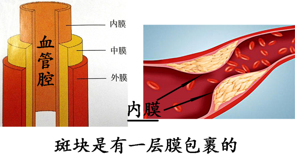 在血管內膜,先後有 脂質和複合糖類積聚,這些積聚物就產生了斑塊