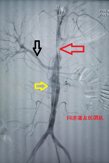 图5 腹主动脉造影,腹主动脉真腔狭窄,右肾动脉显影(黑箭头所示),左肾
