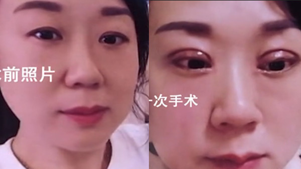 割双眼皮医院排行_江西一女子割双眼皮称像怪物,老公闹着要离婚,美容医院拒绝退费