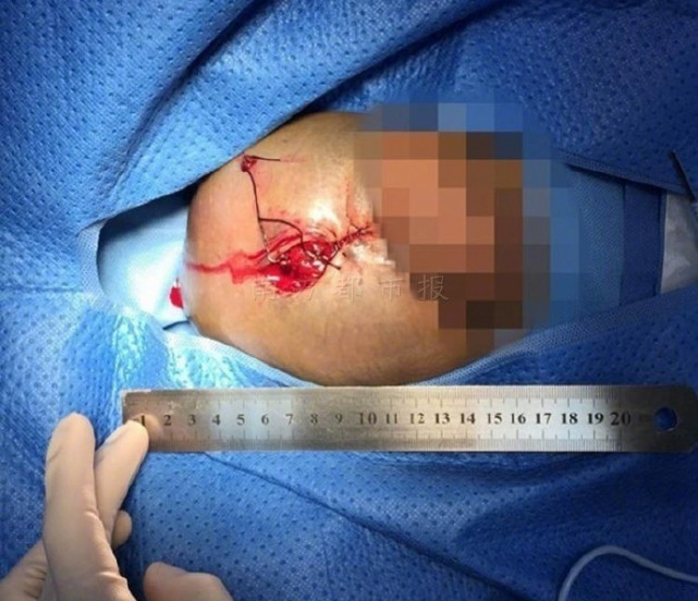 17岁少年家中打麻药自宫不想做男人要做女人