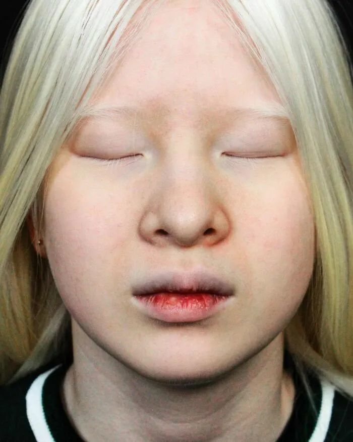 因全身雪白被遗弃的中国女孩逆袭成超模的故事让人泪目