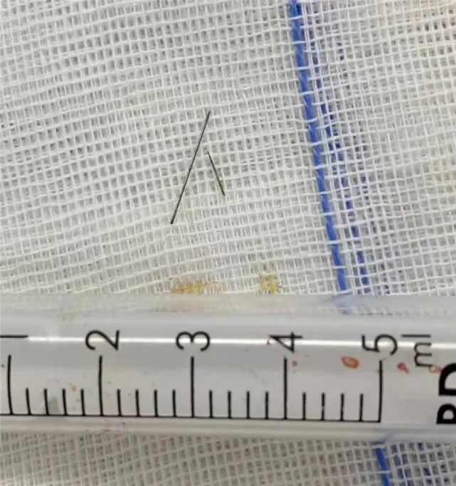 惊险!苏州一女子针灸时发生断针,针头在体内不停游走