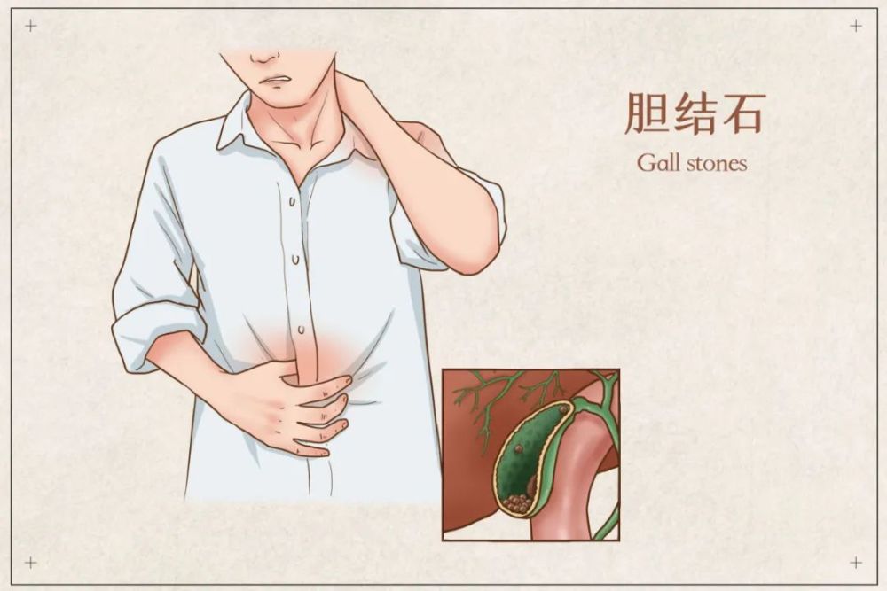 玄技堂中医今天就为大家讲一讲 1,年纪大的人年纪越大的人,胆囊结石