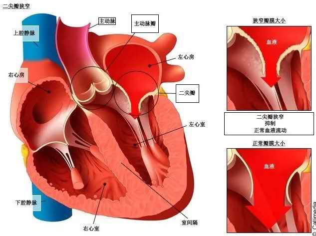 近日,潍坊市中医院心外科团队成功为一位58岁患有二尖瓣脱垂并反流(重