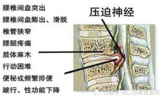 那麼是哪些影響的腰間盤突出1,腰椎間盤的退行性改變:髓核的退變主要