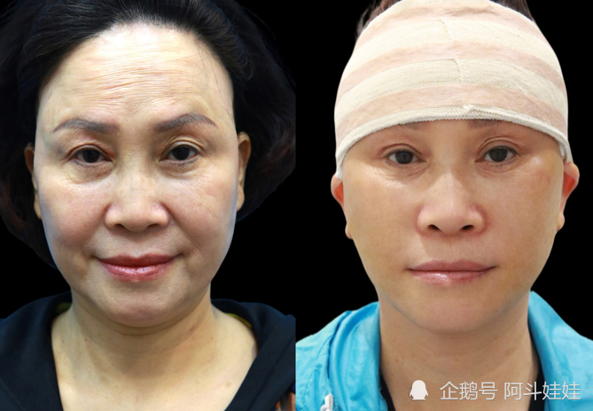 加减美蔡海亮专家讲案例:做拉皮除皱后年轻了10岁,附带对比照