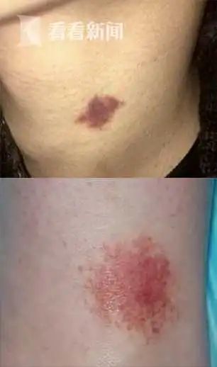 脖子上出现"草莓印"?女友认定是吻痕要分手 男子:冤枉啊