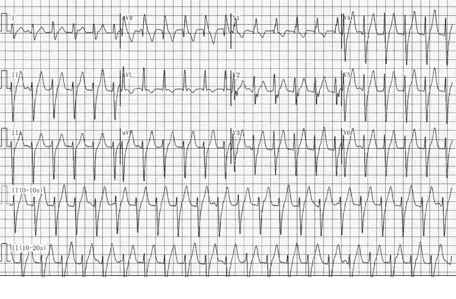 心律失常心电图分析,牢记两项"金规则"