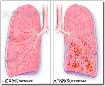 中西醫結合治療肺氣虛型塵肺臨床效果觀察――北京至道中醫研究院賈曉