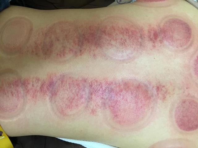 拔完火罐后皮肤表面的淤血是体内的毒素吗不妨来了解