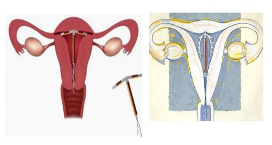 质朴!避孕环是放在哪个位置"实地考察"-第2张图片-马睿网