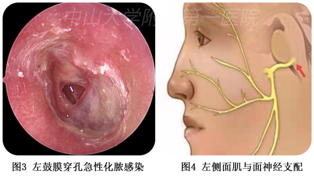听力下降 耳痛难耐 耳朵鼓膜穿孔怎么办 专家来支招 腾讯新闻