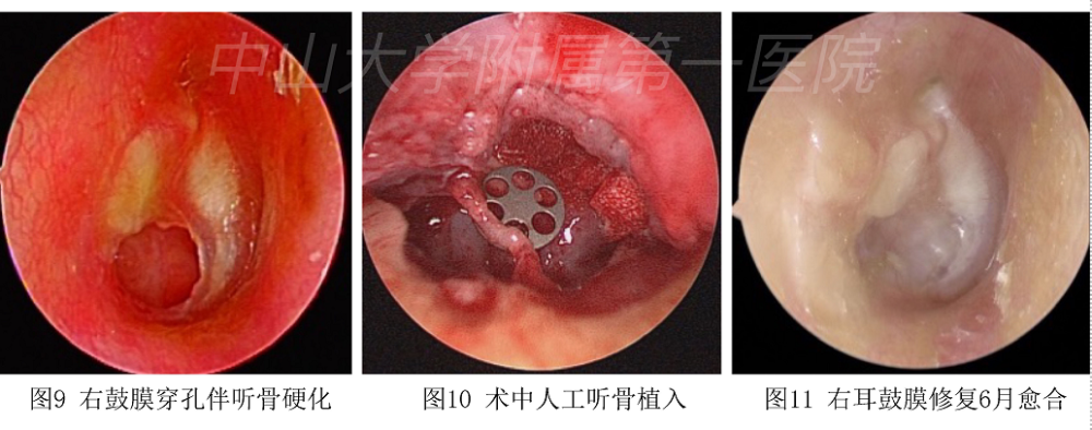 听力下降 耳痛难耐 耳朵鼓膜穿孔怎么办 专家来支招 全网搜