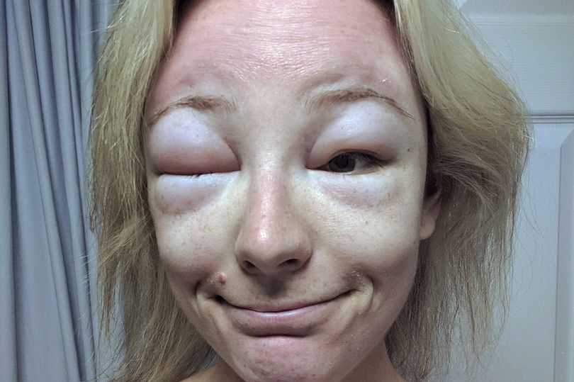 26岁漂亮女子晒太阳后脸肿成了怪物 原因令人警醒