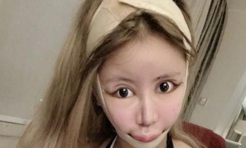 13岁开始整容前后花费100万看到整容后照片网友当场去世