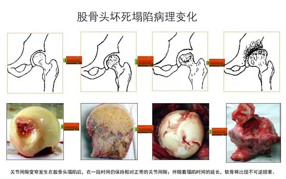 在医学上一般将股骨头坏死分为四期,每期表现出来的症状大体如下:有