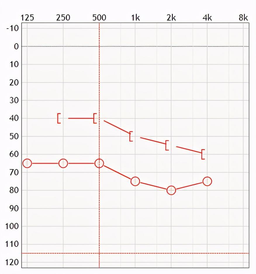 既有传导性聋的病因又有感音神经性聋的病因,感音神经性听力损失听力