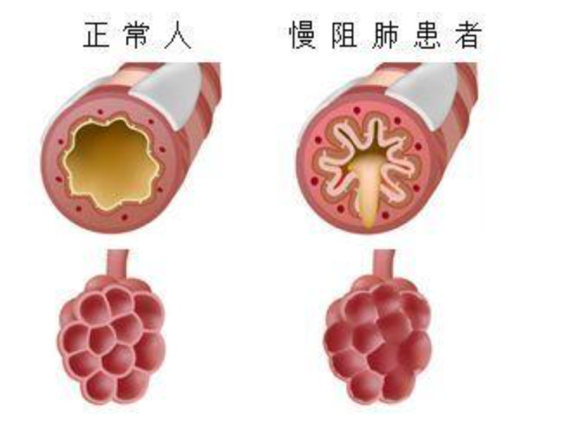 慢阻肺患者活动后有濒死感是否合并心衰主要看这两点症状