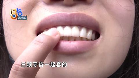 小祝:"他就把我中间这颗门牙,把这颗多生牙拔了之后,然后这两颗门牙