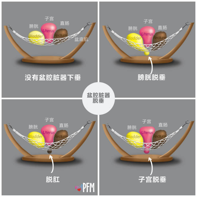 每个女生都应预防|子宫|盆腔器官脱垂|盆底|子宫脱垂