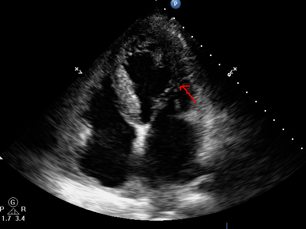 曾经误以为的"降落伞样二尖瓣"